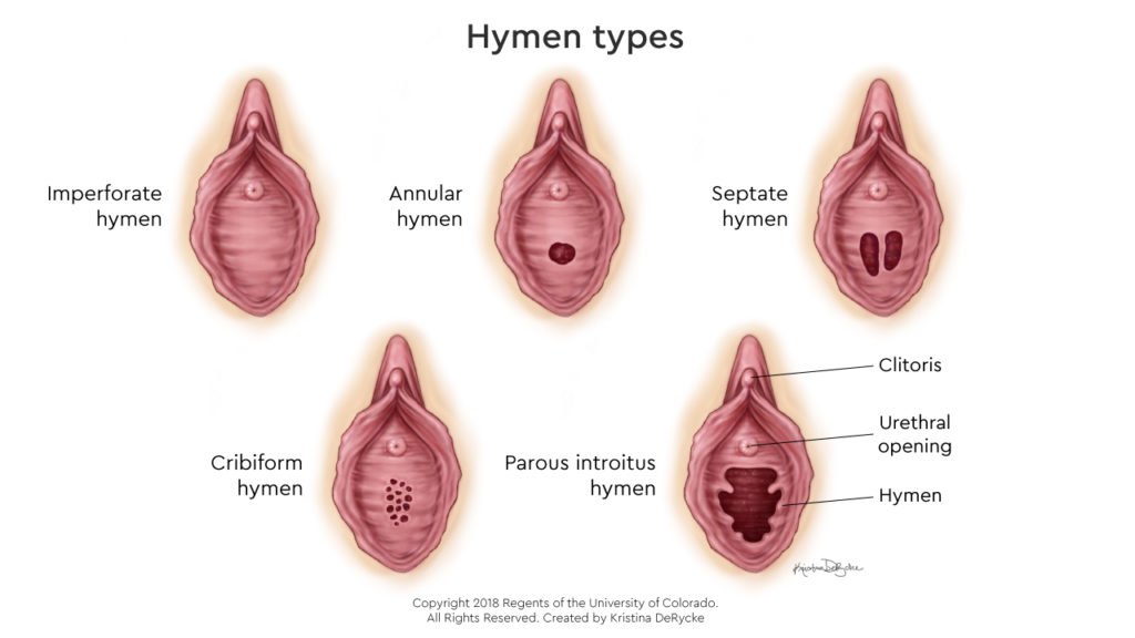 Tipe-Tipe Himen