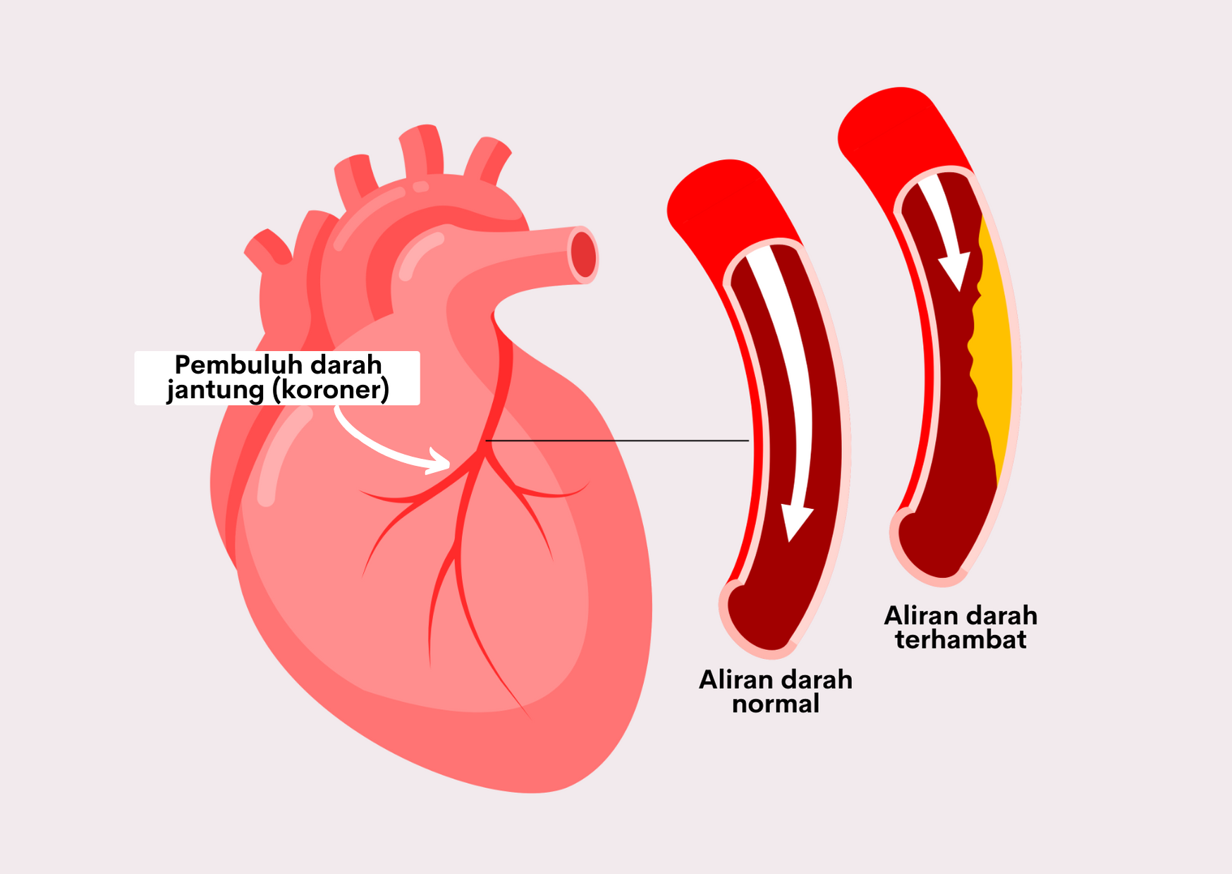 Aliran Darah Normal dan Jantung Koroner