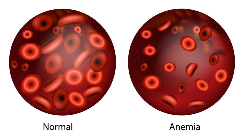 Kondisi Darah Normal dan Anemia